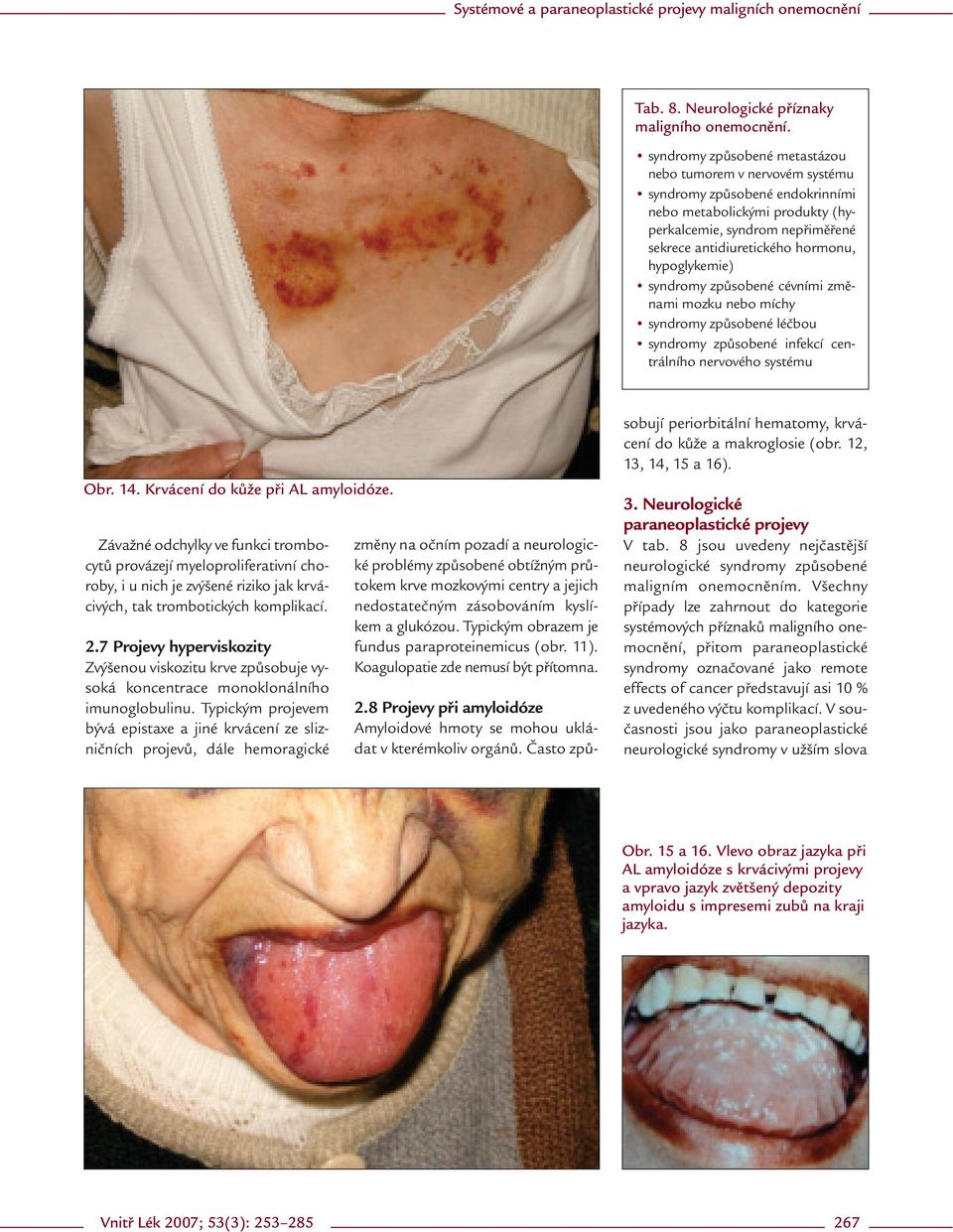 hypoglykemie) syndromy způsobené cévními změnami mozku nebo míchy syndromy způsobené léčbou syndromy způsobené infekcí centrálního nervového systému Obr. 14. Krvácení do kůže při AL amyloidóze.