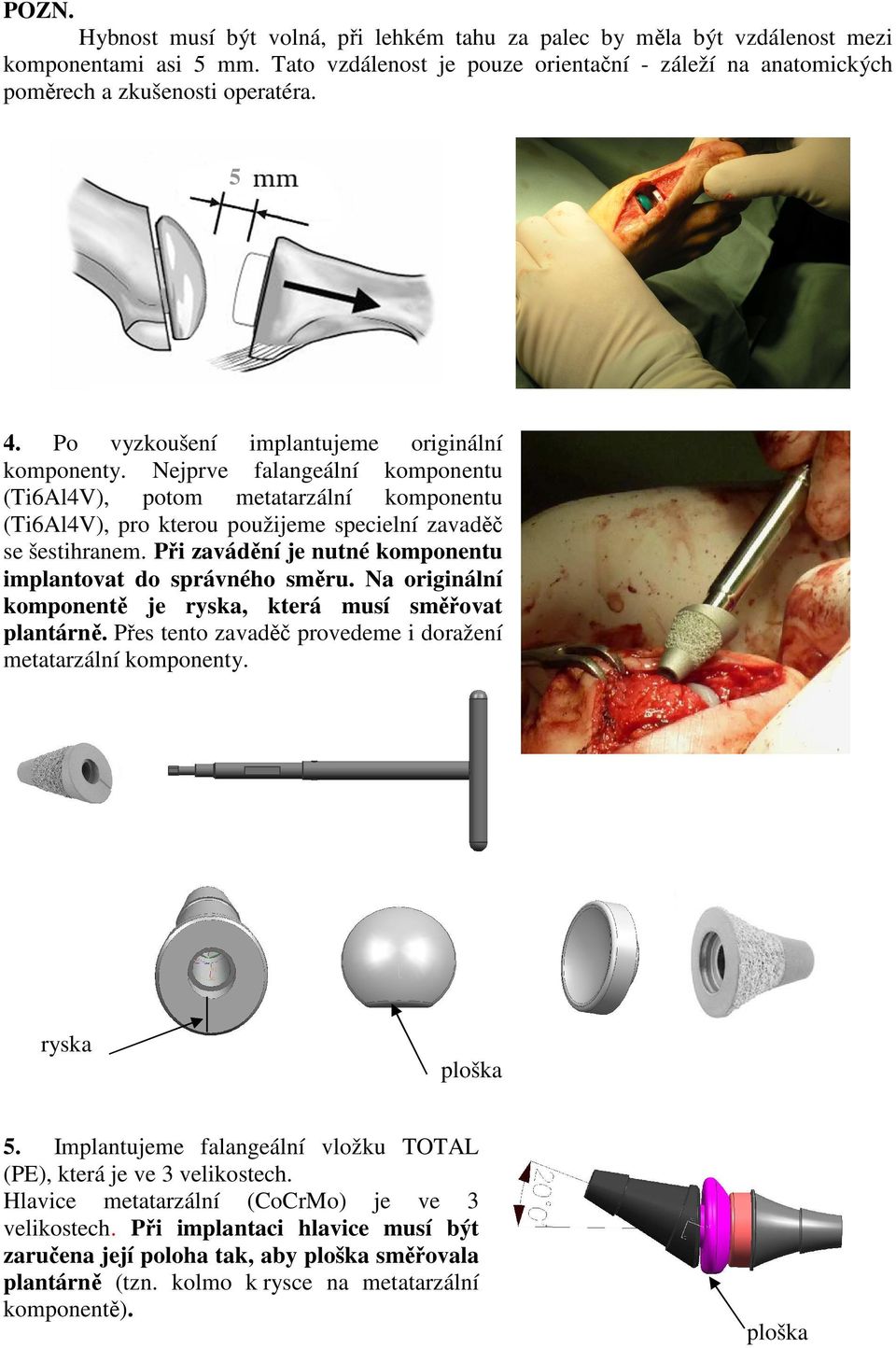 Při zavádění je nutné komponentu implantovat do správného směru. Na originální komponentě je ryska, která musí směřovat plantárně. Přes tento zavaděč provedeme i doražení metatarzální komponenty.