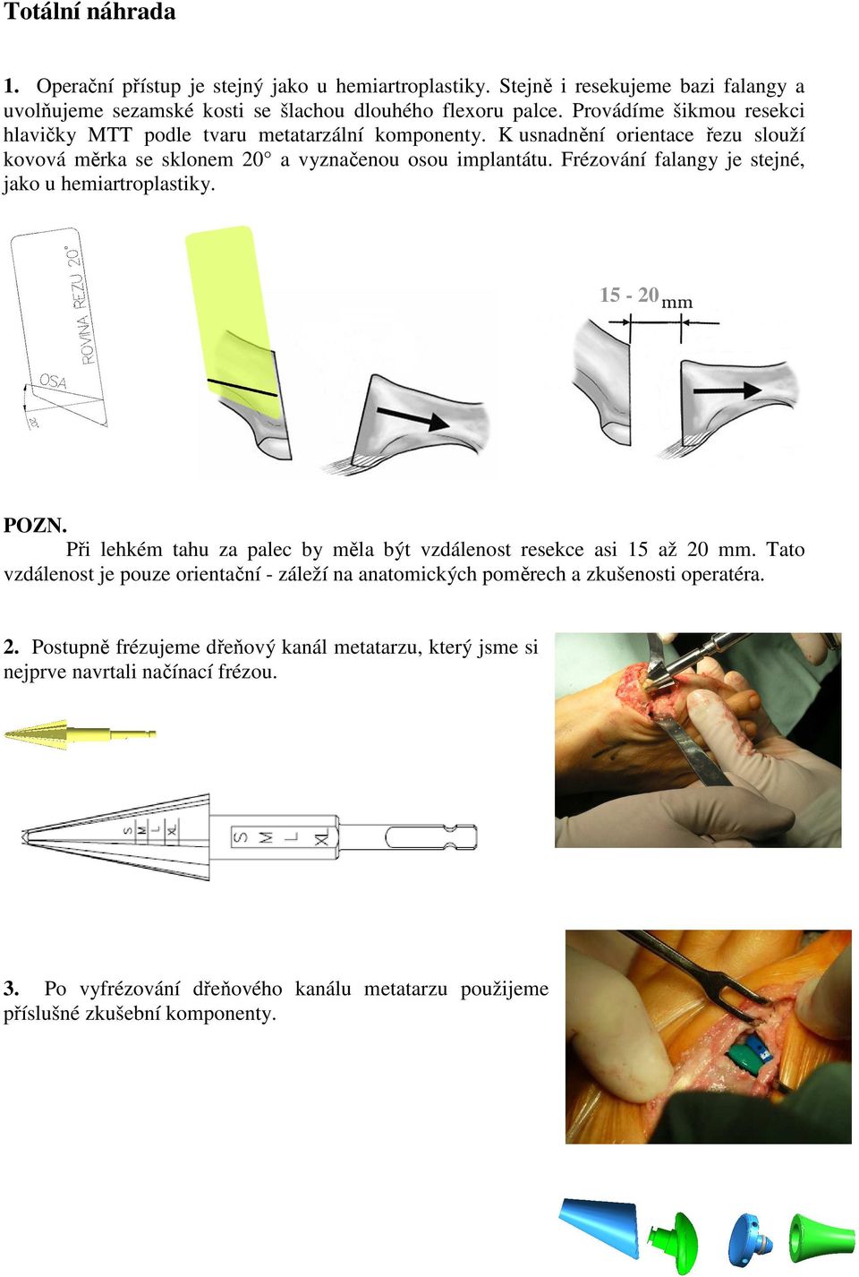 Frézování falangy je stejné, jako u hemiartroplastiky. 15-20 POZN. Při lehkém tahu za palec by měla být vzdálenost resekce asi 15 až 20 mm.