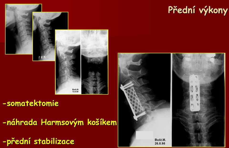 -náhrada Harmsovým