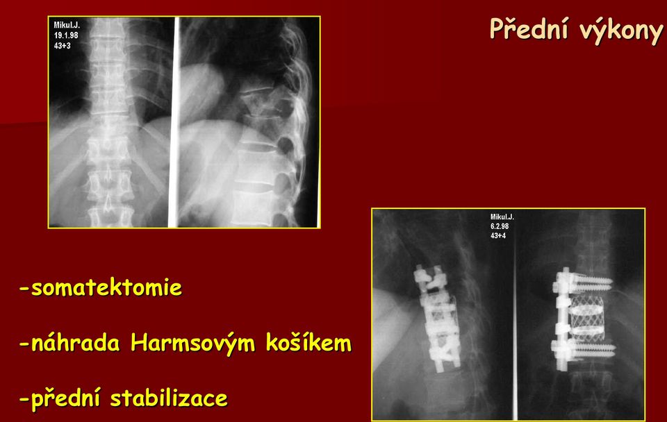 -náhrada Harmsovým