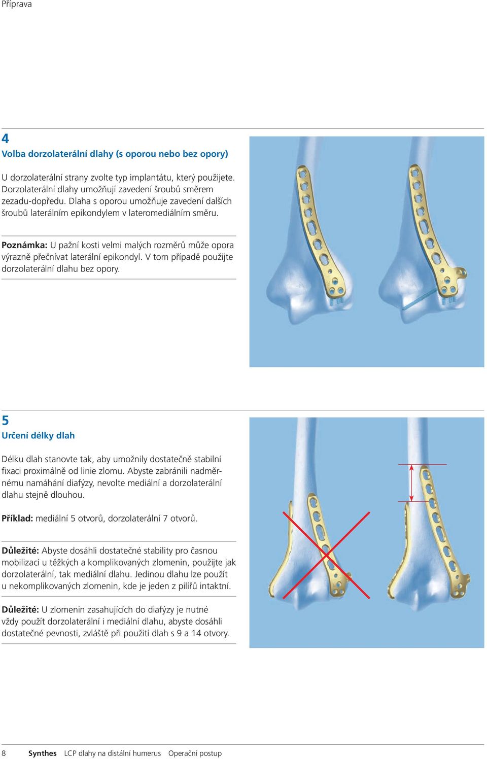 V tom případě použijte dorzolaterální dlahu bez opory. 5 Určení délky dlah Délku dlah stanovte tak, aby umožnily dostatečně stabilní fixaci proximálně od linie zlomu.