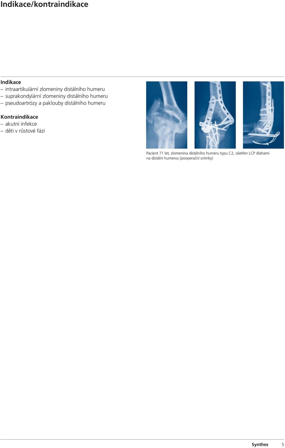 humeru Kontraindikace akutní infekce děti v růstové fázi Pacient 71 let, zlomenina