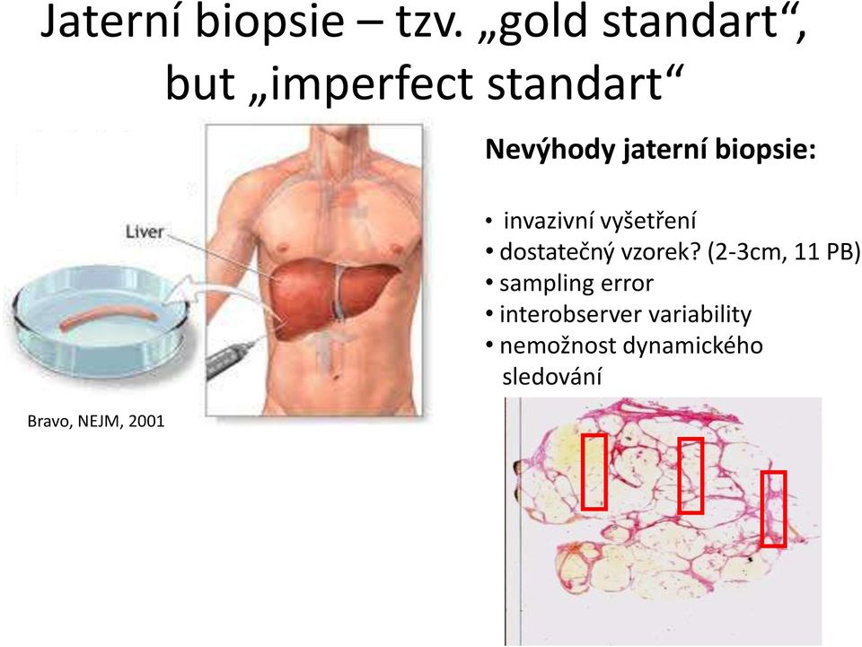 Nevýhody jaterní biopsie: invazivní vyšetření dostatečný