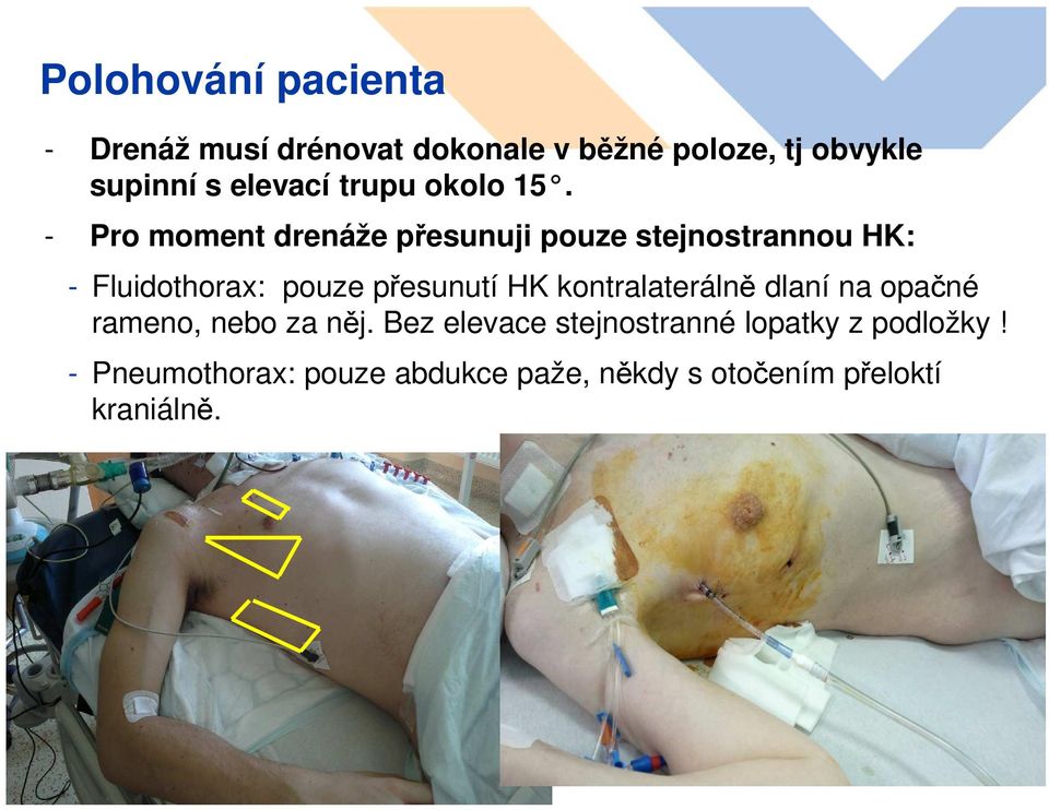 - Pro moment drenáže přesunuji pouze stejnostrannou HK: - Fluidothorax: pouze přesunutí HK