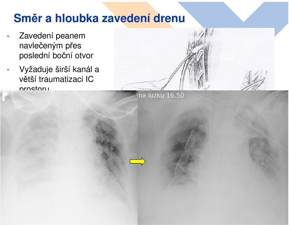 Obvykle u hemotoraxů/pyothoraxů a 32F- 36F drenů, které se dodávají bez