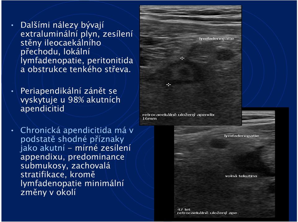 Periapendikální zánět se vyskytuje u 98% akutních apendicitid Chronická apendicitida má v podstatě