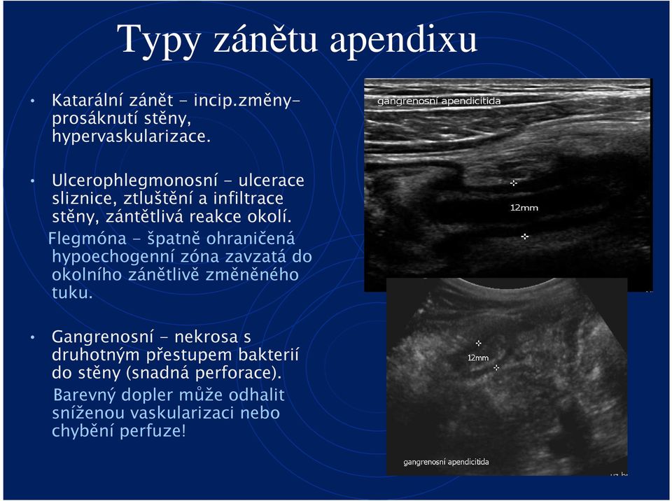 Flegmóna - špatně ohraničená hypoechogenní zóna zavzatá do okolního zánětlivě změněného tuku.