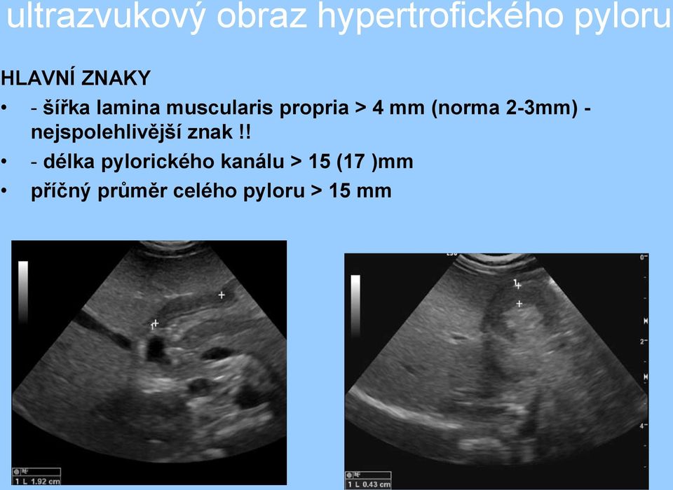 (norma 2-3mm) - nejspolehlivější znak!