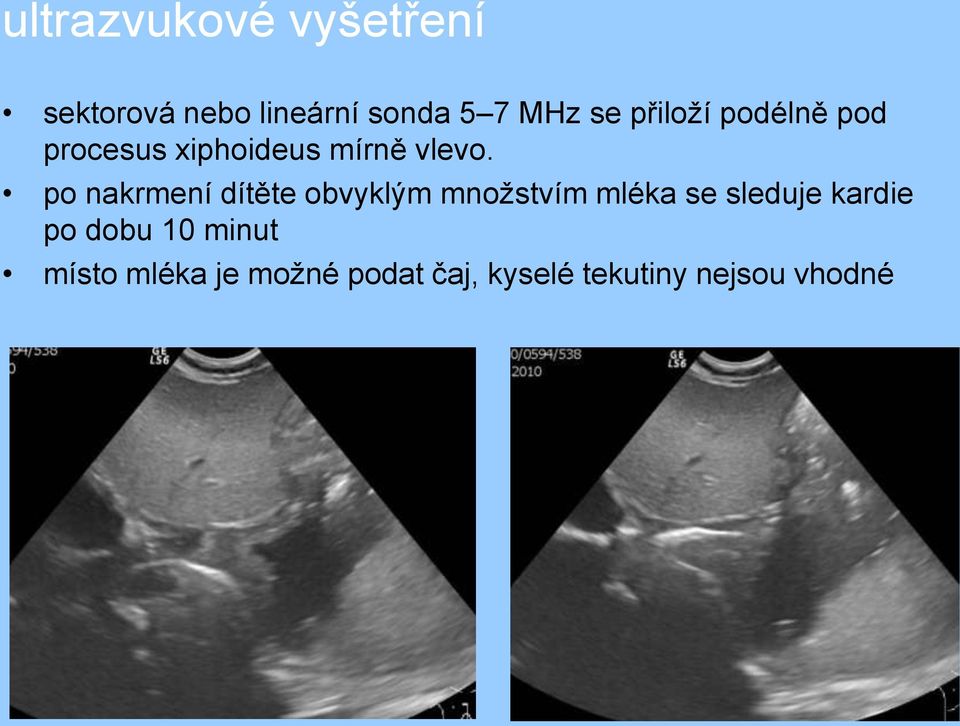 po nakrmení dítěte obvyklým množstvím mléka se sleduje kardie po