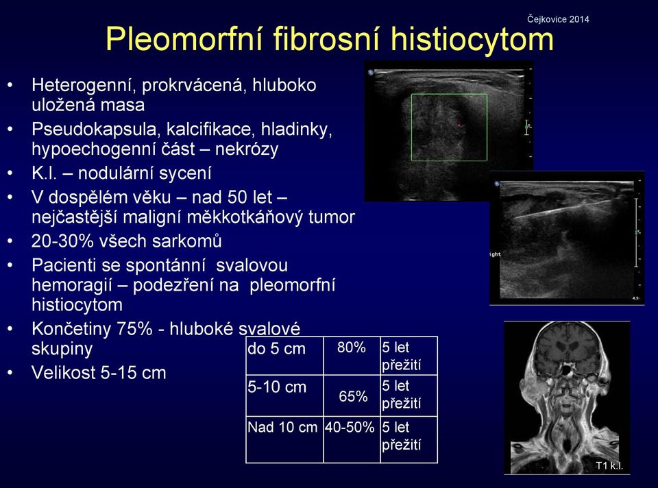 tumor 20-30% všech sarkomů Pacienti se spontánní svalovou hemoragií podezření na pleomorfní histiocytom Končetiny 75% -