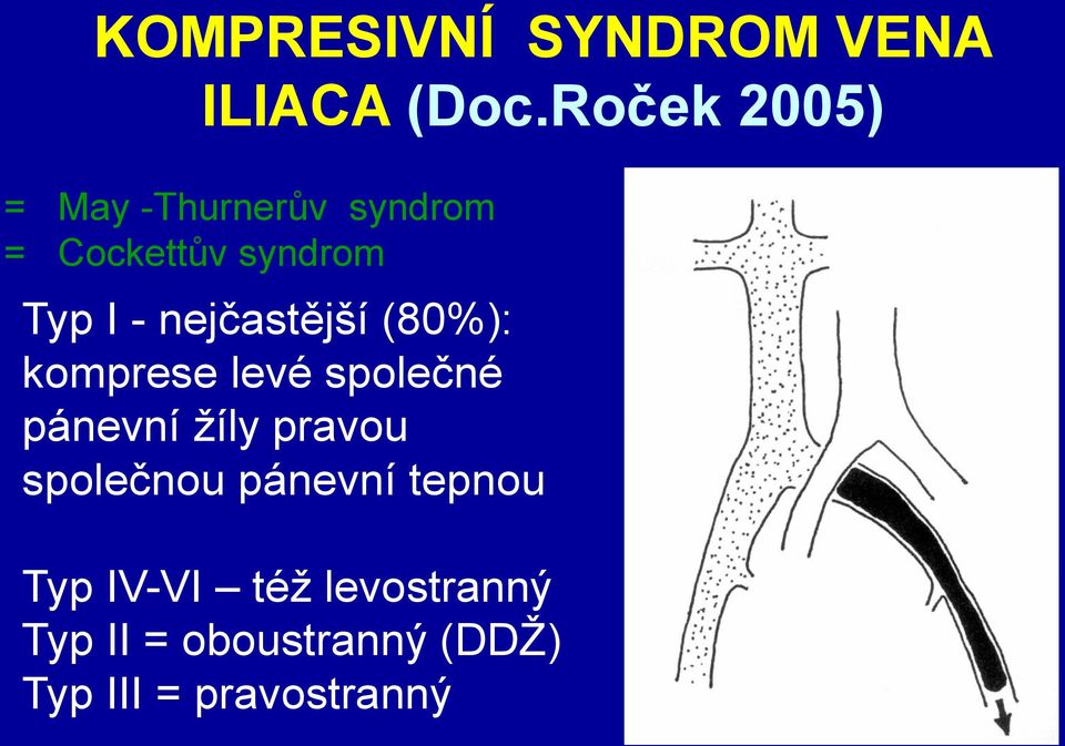 nejčastější (80%): komprese levé společné pánevní žíly pravou