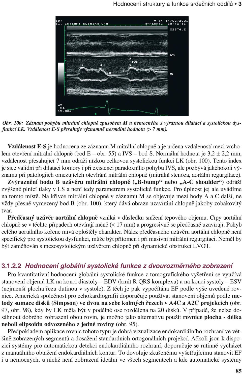 55) a IVS bod S. Normální hodnota je 3,2 ± 2,2 mm, vzdálenost přesahující 7 mm odráží nízkou celkovou systolickou funkci LK (obr. 100).