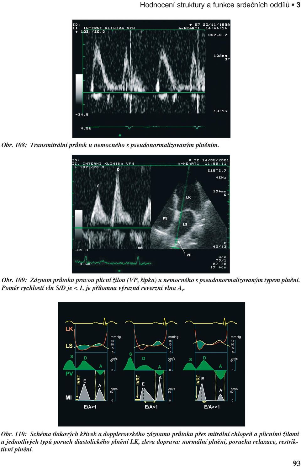 109: Záznam průtoku pravou plicní žilou (VP, šipka) u nemocného s pseudonormalizovaným typem plnění.