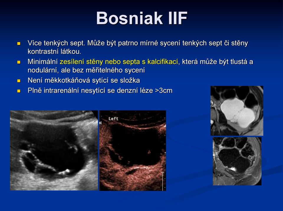 Minimální zesílení stěny nebo septa s kalcifikací, která může být tlustá