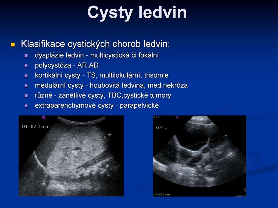 multilokulární, trisomie medulární cysty - houbovitá ledvina, med.