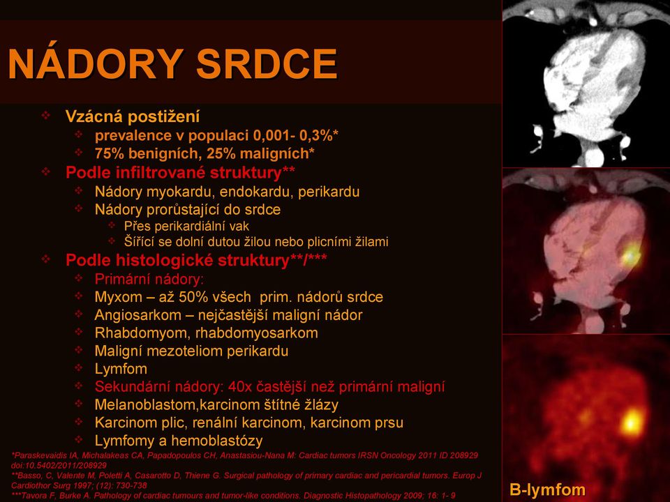 nádorů srdce Angiosarkom nejčastější maligní nádor Rhabdomyom, rhabdomyosarkom Maligní mezoteliom perikardu Lymfom Sekundární nádory: 40x častější než primární maligní Melanoblastom,karcinom štítné