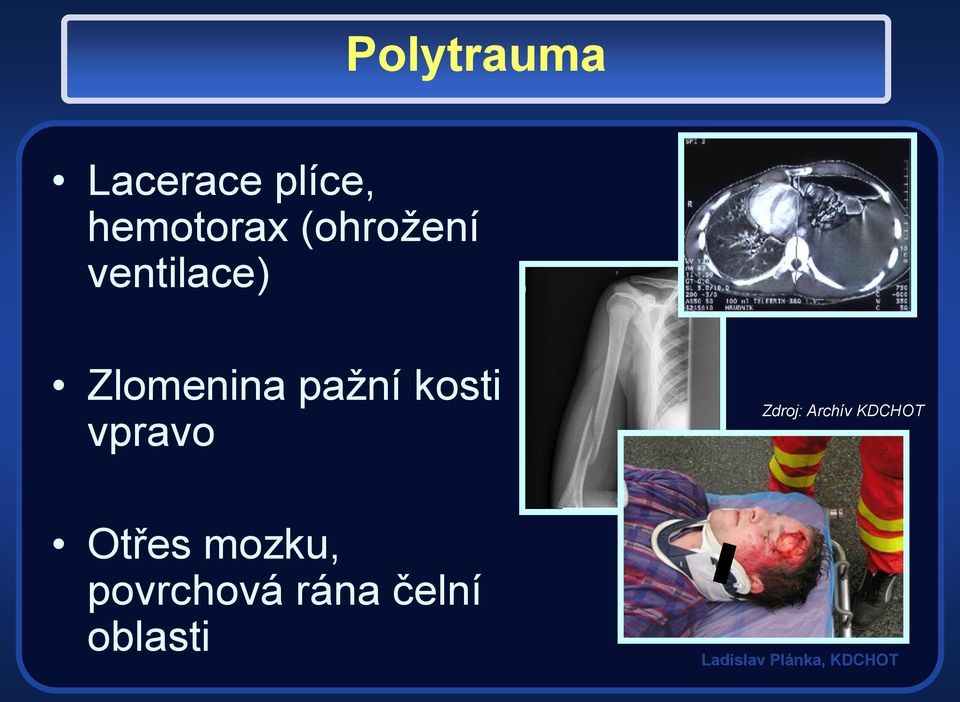 kosti vpravo Otřes mozku, povrchová