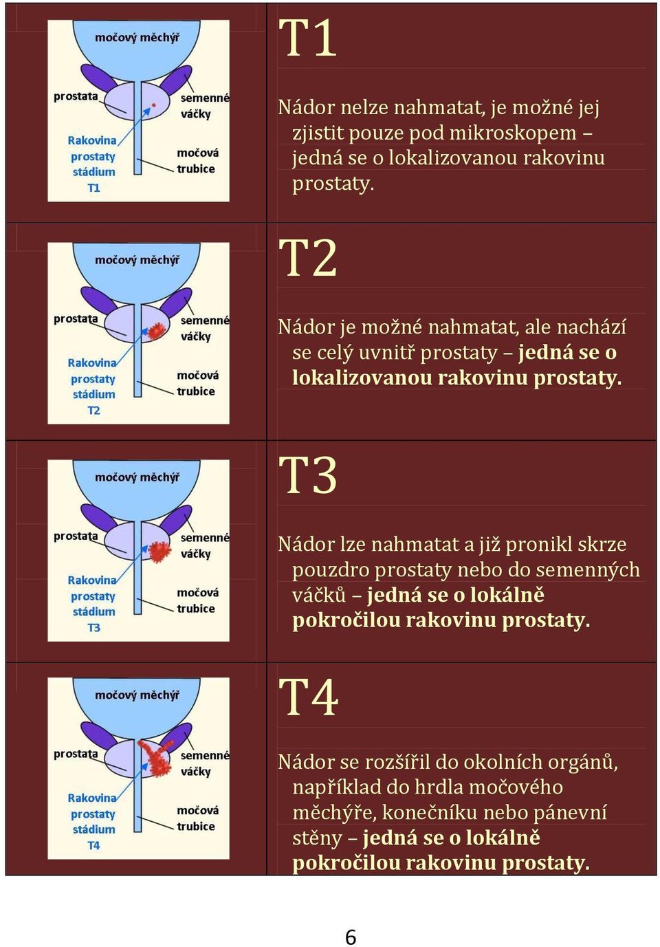T3 Nádor lze nahmatat a již pronikl skrze pouzdro prostaty nebo do semenných váčků jedná se o lokálně pokročilou rakovinu