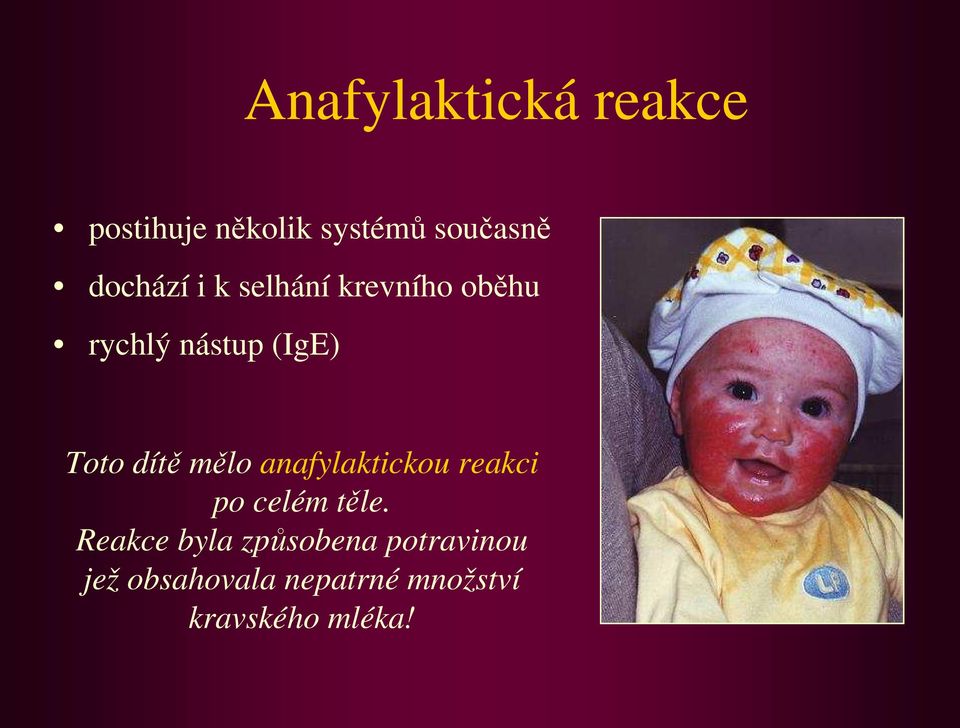 dítě mělo anafylaktickou reakci po celém těle.