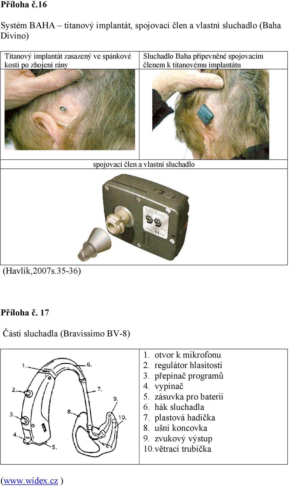 zhojení rány Sluchadlo Baha připevněné spojovacím členem k titanovému implantátu spojovací člen a vlastní sluchadlo (Havlík,2007s.