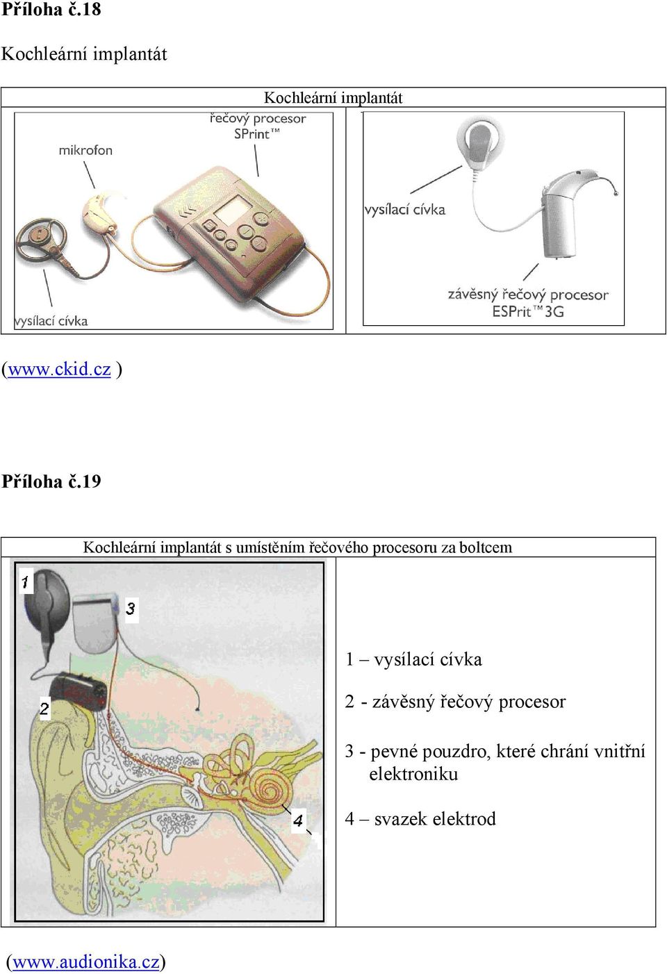 19 Kochleární implantát s umístěním řečového procesoru za boltcem 1