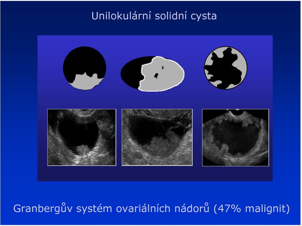 Granbergův systém