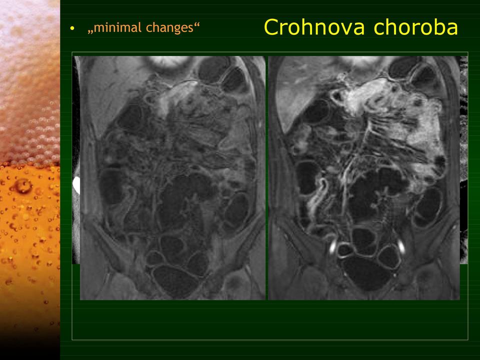 Crohnova