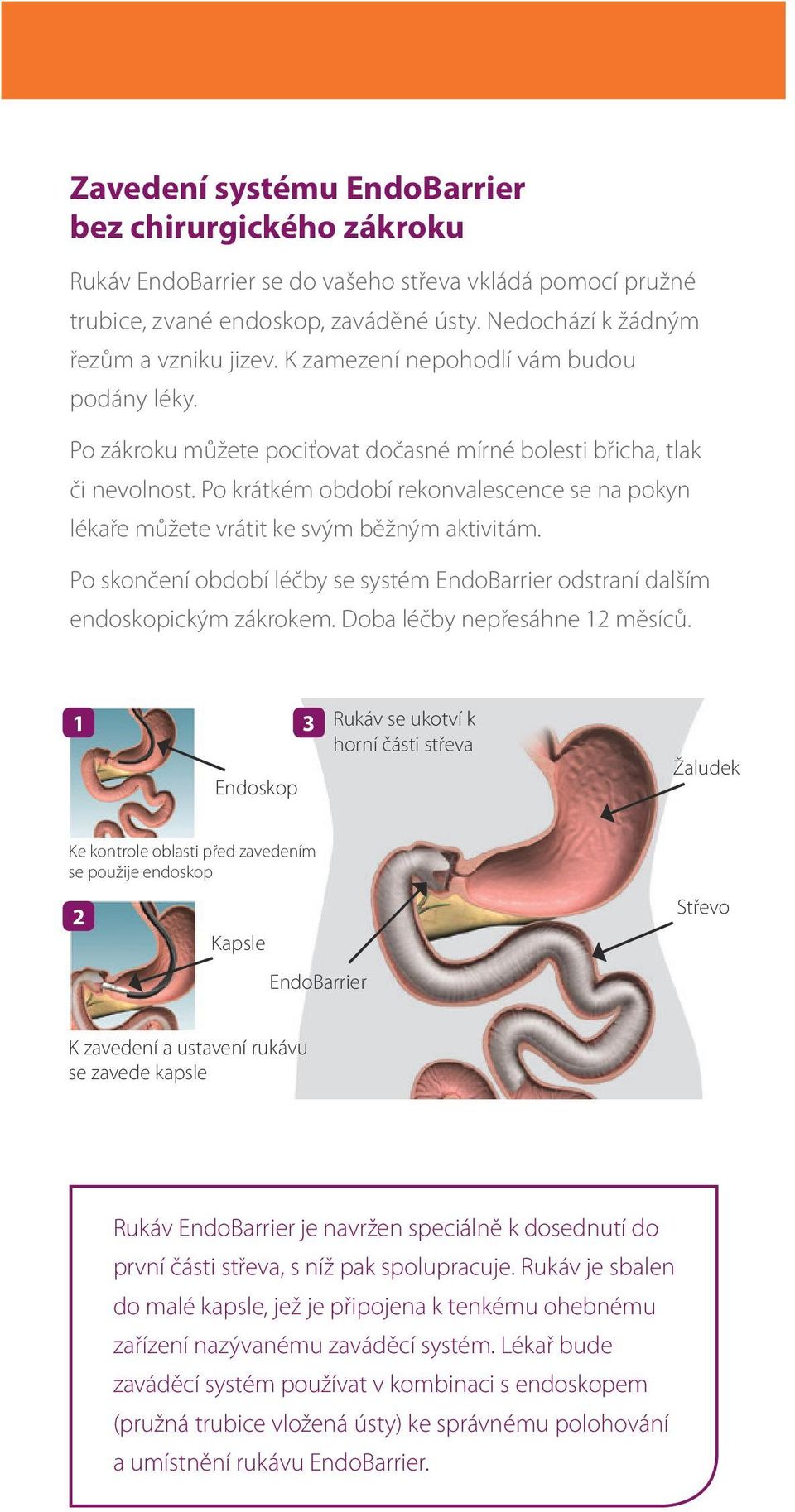 Po krátkém období rekonvalescence se na pokyn lékaře můžete vrátit ke svým běžným aktivitám. Po skončení období léčby se systém EndoBarrier odstraní dalším endoskopickým zákrokem.