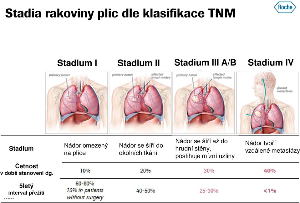 okolních tkání Nádor se šíří až do hrudní stěny, postihuje mízní uzliny