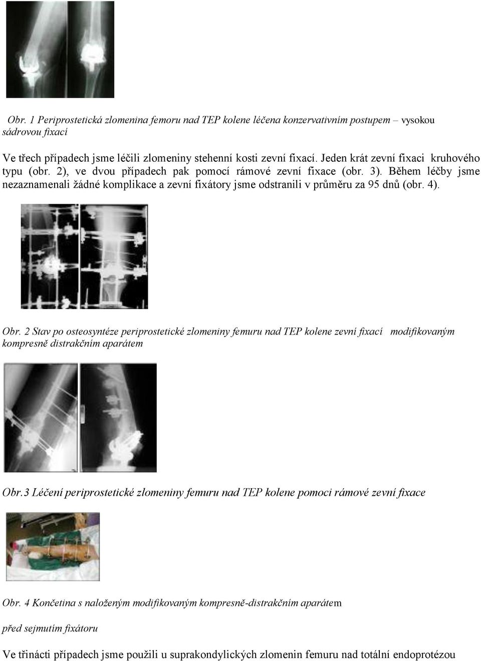 Během léčby jsme nezaznamenali žádné komplikace a zevní fixátory jsme odstranili v průměru za 95 dnů (obr. 4). Obr.