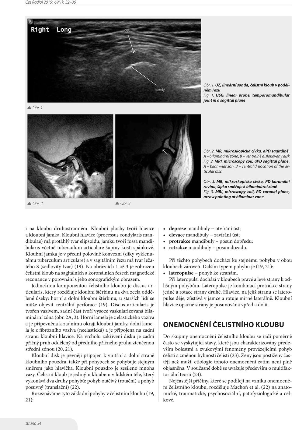 Obr. 3. MR, mikroskopická cívka, PD koronální rovina, šipka směřuje k bilaminární zóně Fig. 3. MRI, microscopy coil, PD coronal plane, arrow pointing at bilaminar zone i na kloubu druhostranném.