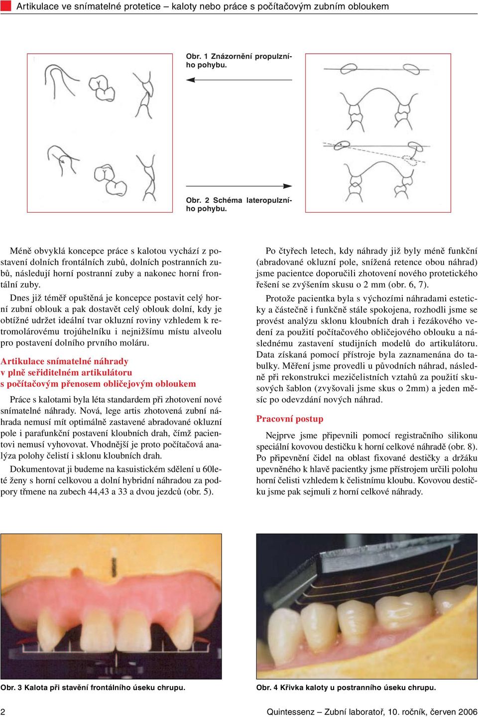 Dnes již téměř opuštěná je koncepce postavit celý horní zubní oblouk a pak dostavět celý oblouk dolní, kdy je obtížné udržet ideální tvar okluzní roviny vzhledem k retromolárovému trojúhelníku i