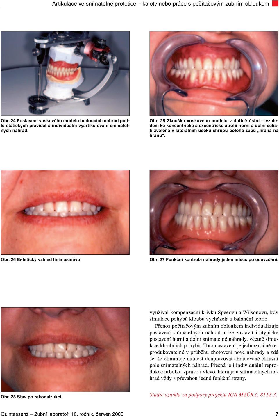 26 Estetický vzhled linie úsměvu. Obr. 27 Funkční kontrola náhrady jeden měsíc po odevzdání. využíval kompenzační křivku Speeovu a Wilsonovu, kdy simulace pohybů kloubu vycházela z balanční teorie.