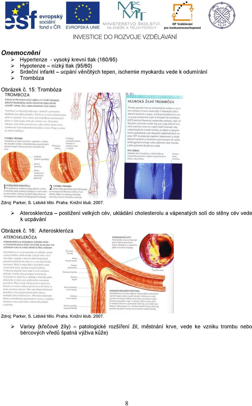 15: Trombóza Ateroskleróza postižení velkých cév, ukládání cholesterolu a vápenatých solí do stěny cév vede k