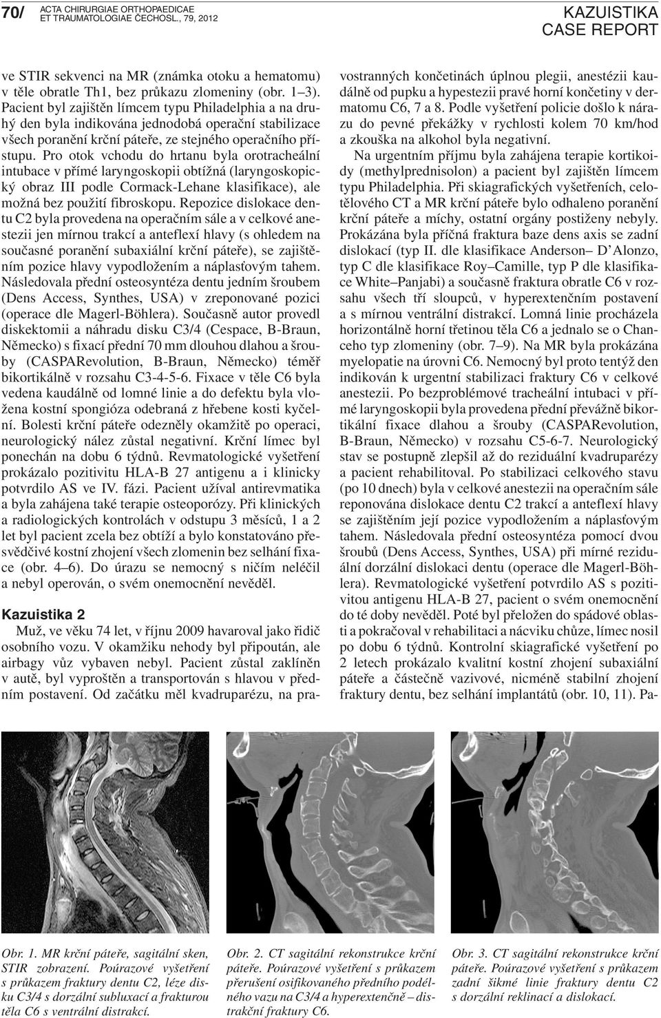 Pro otok vchodu do hrtanu byla orotracheální intubace v přímé laryngoskopii obtížná (laryngoskopický obraz III podle Cormack-Lehane klasifikace), ale možná bez použití fibroskopu.