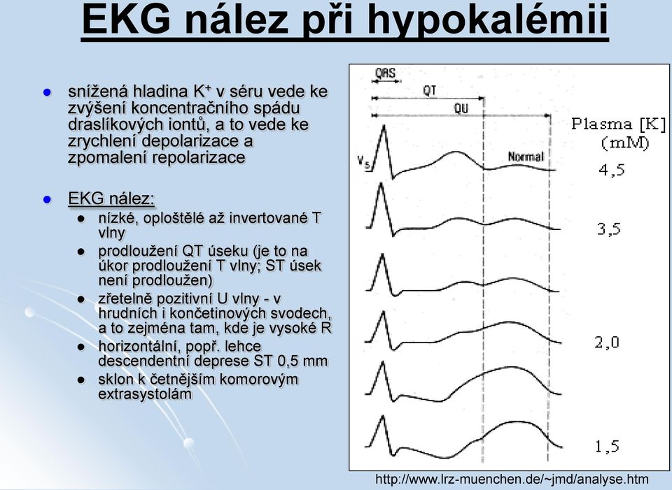 T vlny; ST úsek není prodloužen) zřetelně pozitivní U vlny - v hrudních i končetinových svodech, a to zejména tam, kde je vysoké R