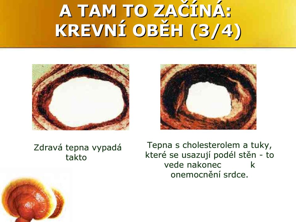 cholesterolem a tuky, které se usazují