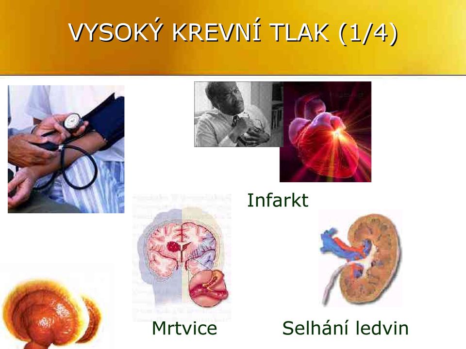 Infarkt
