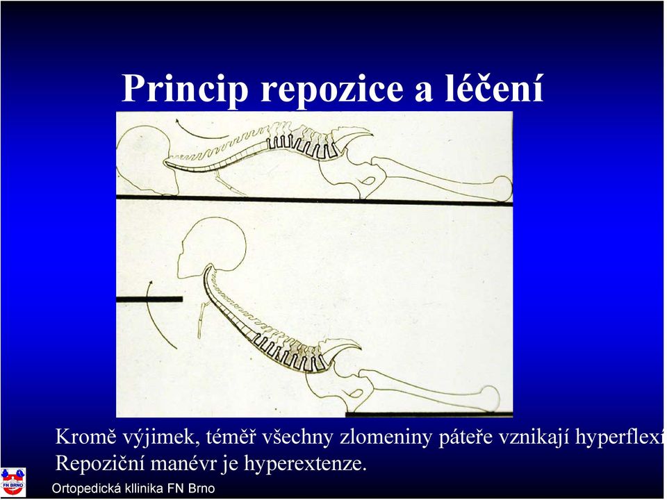 zlomeniny páteře vznikají