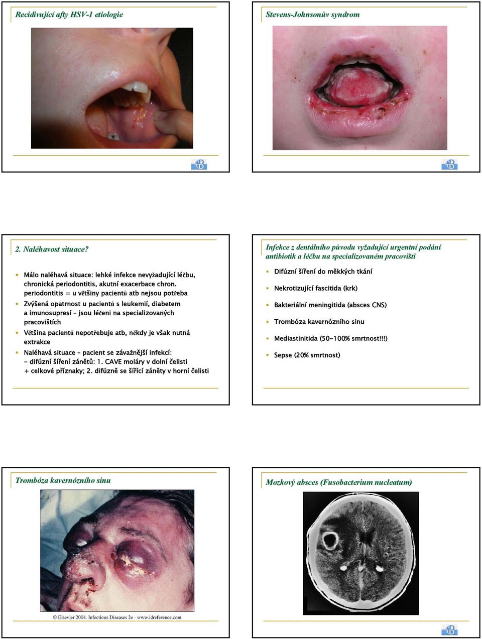 periodontitis = u většiny v pacientů atb nejsou potřeba Zvýšen ená opatrnost u pacientů s leukemií,, diabetem a imunosupresí jsou léčeni l na specializovaných pracovištích ch Většina pacientů