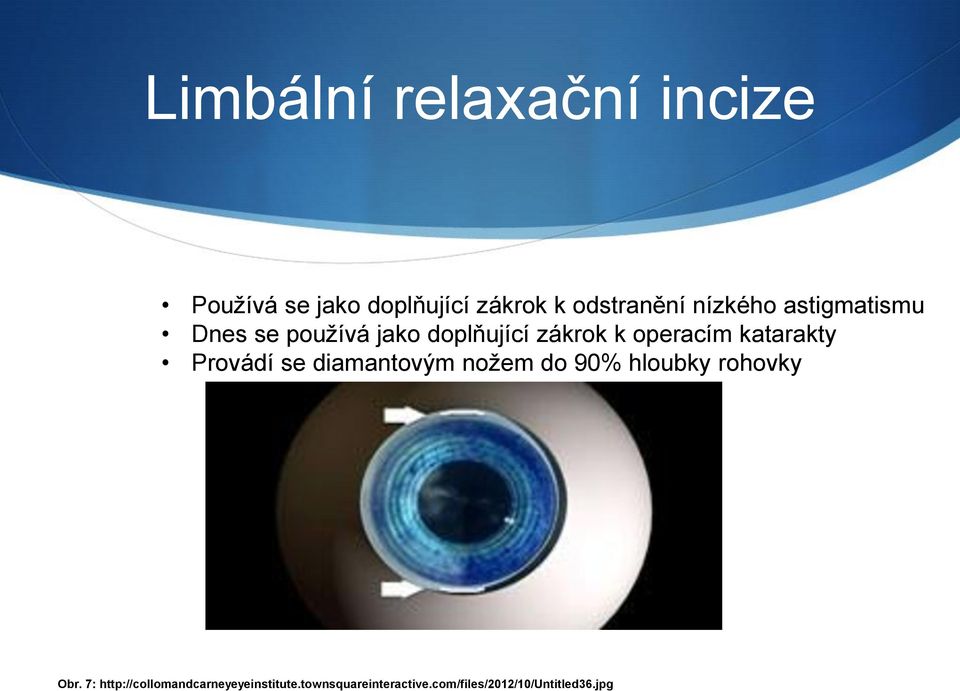 katarakty Provádí se diamantovým nožem do 90% hloubky rohovky Obr.