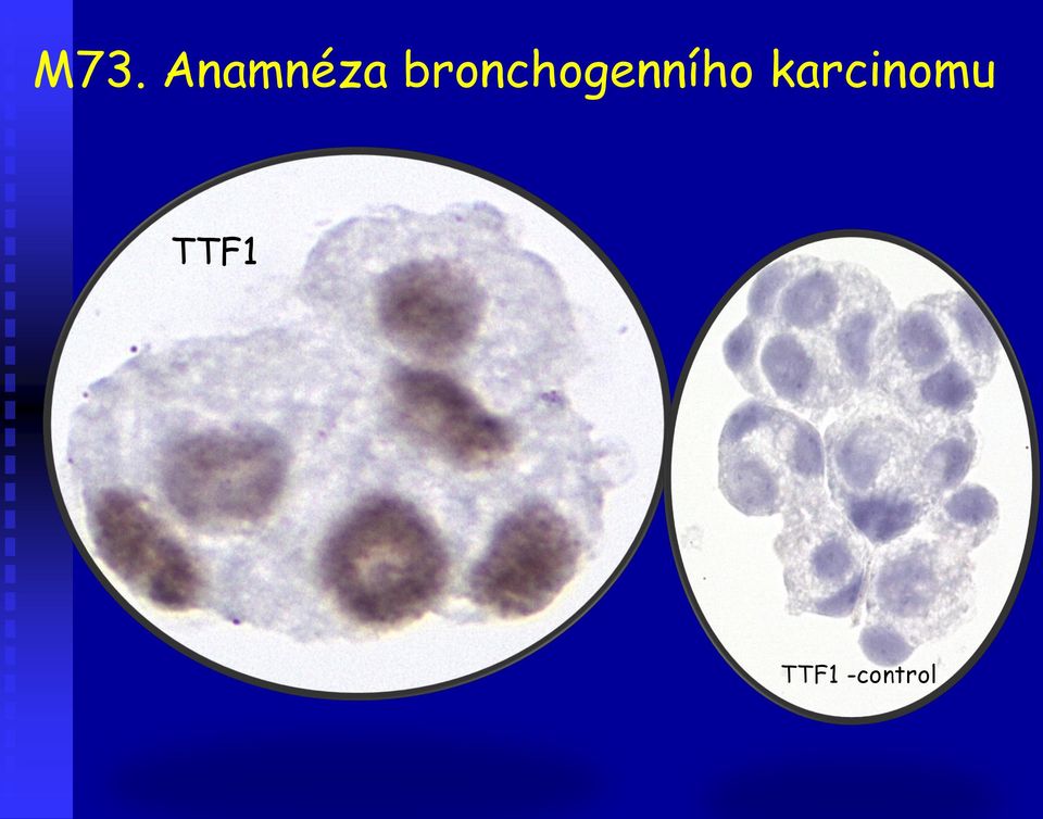 karcinomu TTF1