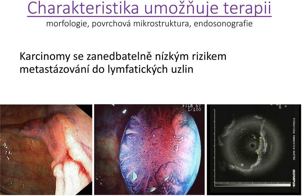 endosonografie Karcinomy se zanedbatelně