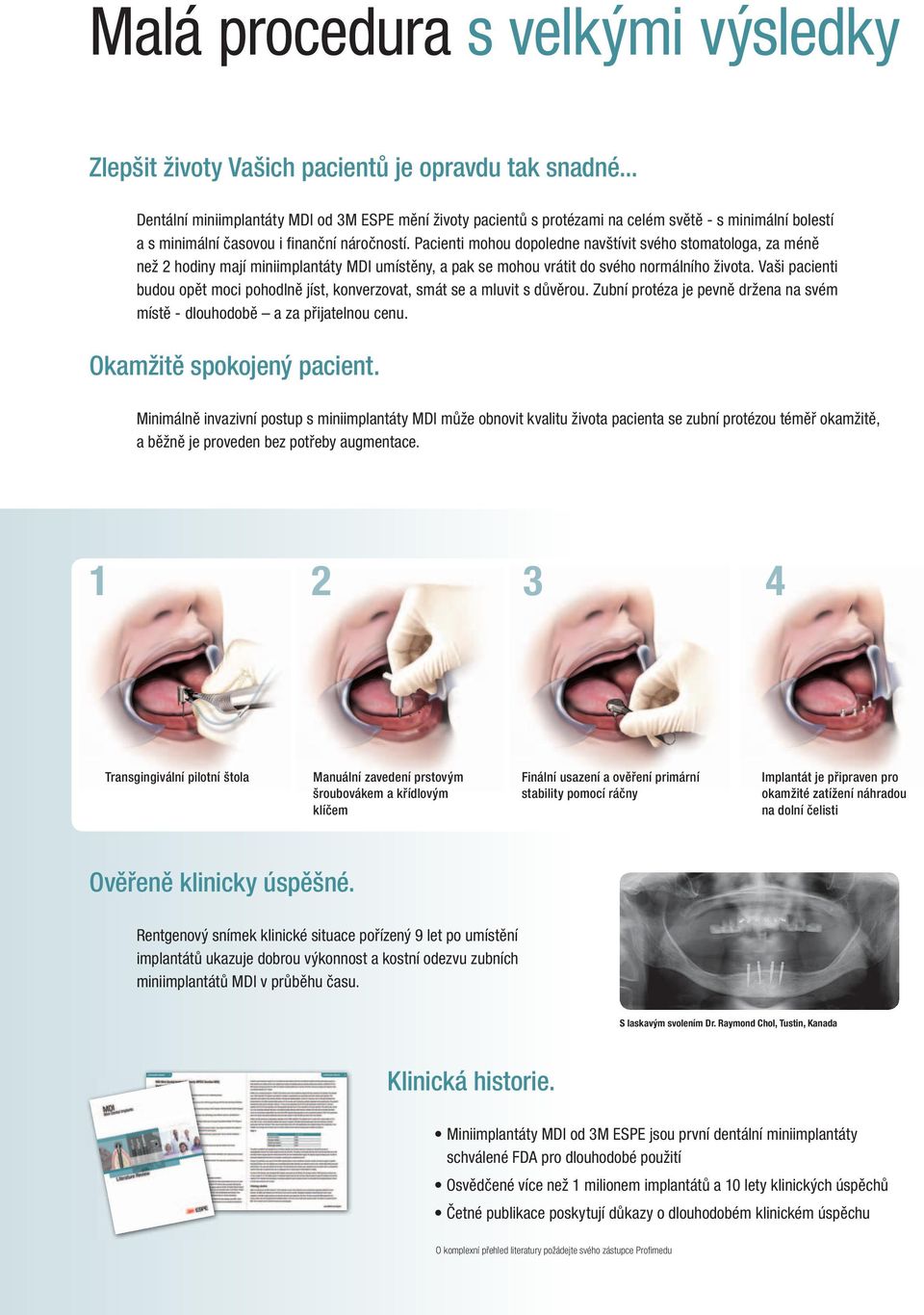 Pacienti mohou dopoledne navštívit svého stomatologa, za méně než 2 hodiny mají miniimplantáty MDI umístěny, a pak se mohou vrátit do svého normálního života.