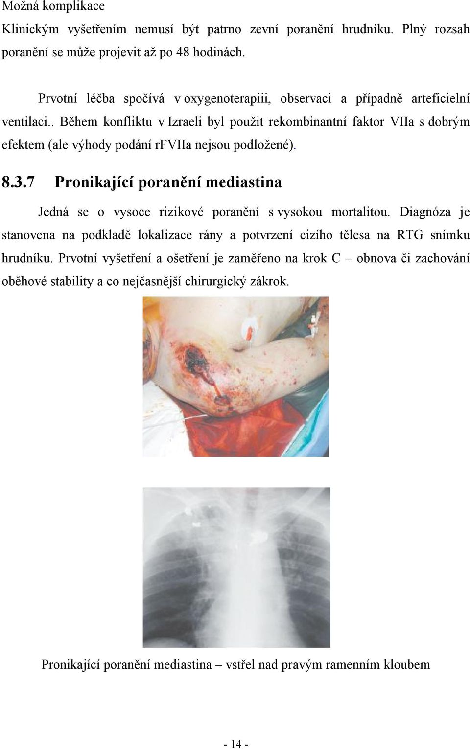 . Během konfliktu v Izraeli byl použit rekombinantní faktor VIIa s dobrým efektem (ale výhody podání rfviia nejsou podložené). 8.3.