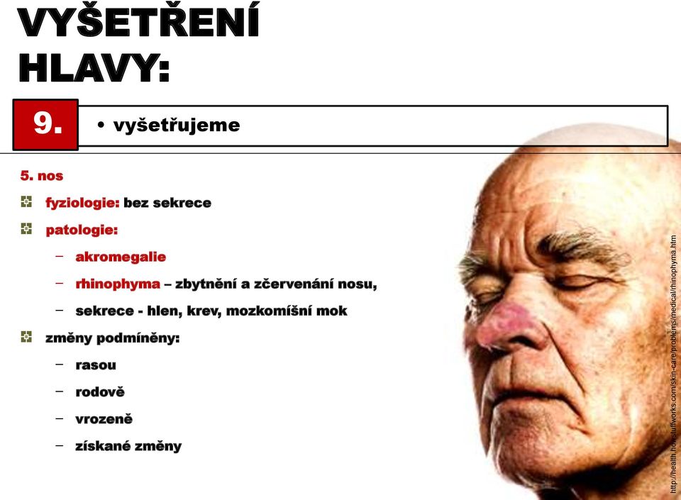 nos fyziologie: bez sekrece patologie: - akromegalie - rhinophyma zbytnění