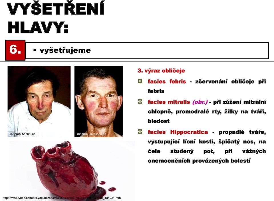 ) - při zúžení mitrální chlopně, promodralé rty, žilky na tváři, bledost facies Hippocratica - propadlé tváře,