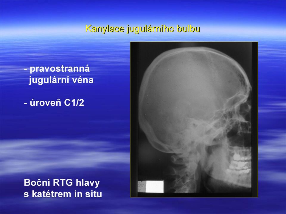 véna - úroveň C1/2 Boční