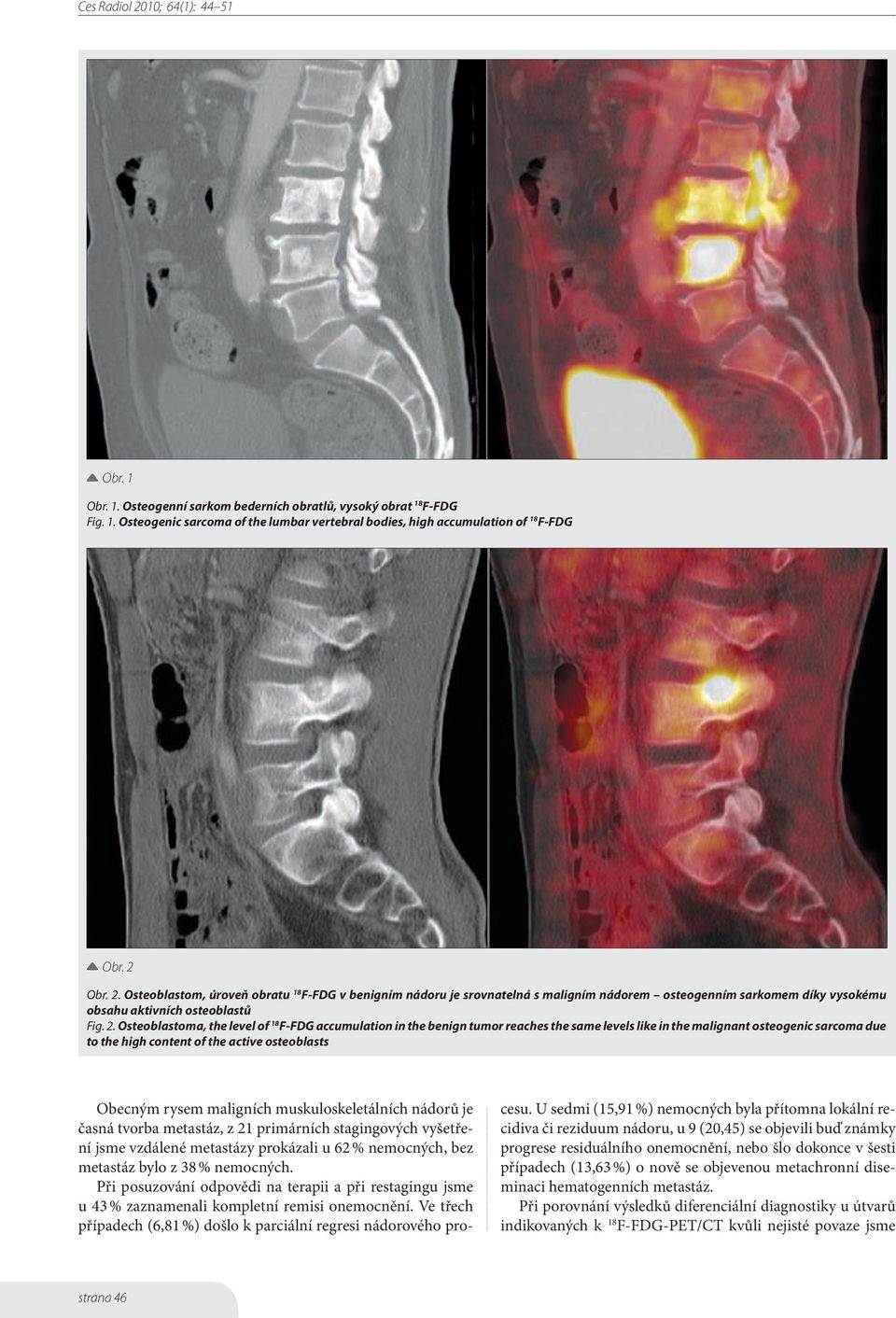 Osteoblastom, úroveň obratu 18 F-FDG v benigním nádoru je srovnatelná s maligním nádorem osteogenním sarkomem díky vysokému obsahu aktivních osteoblastů Fig. 2.